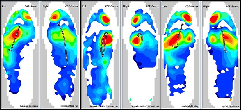 Plantar Pressures 1